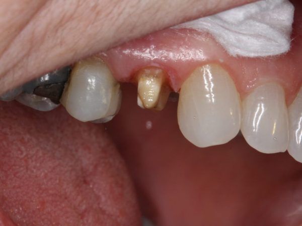 Crown preparation documented for precise lab fabrication