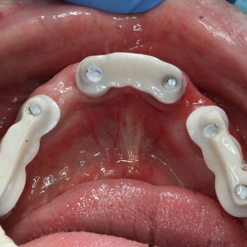 Milled implant frameworks at clinical try-in